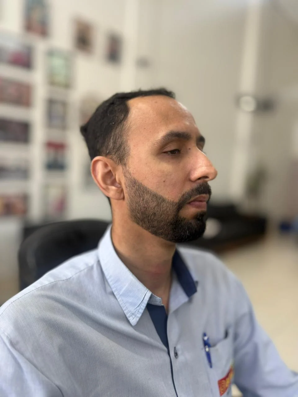 Depois da micropigmentação de barba