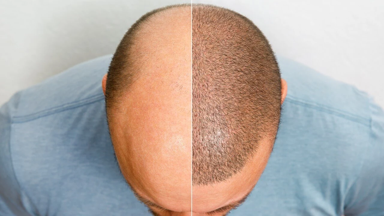 Antes e depois de tratamento para calvície masculina