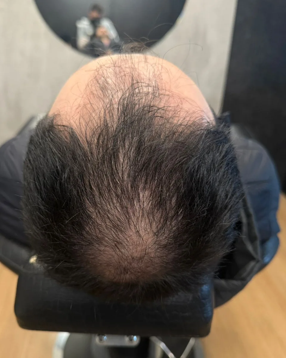 Antes do tratamento de calvície masculina