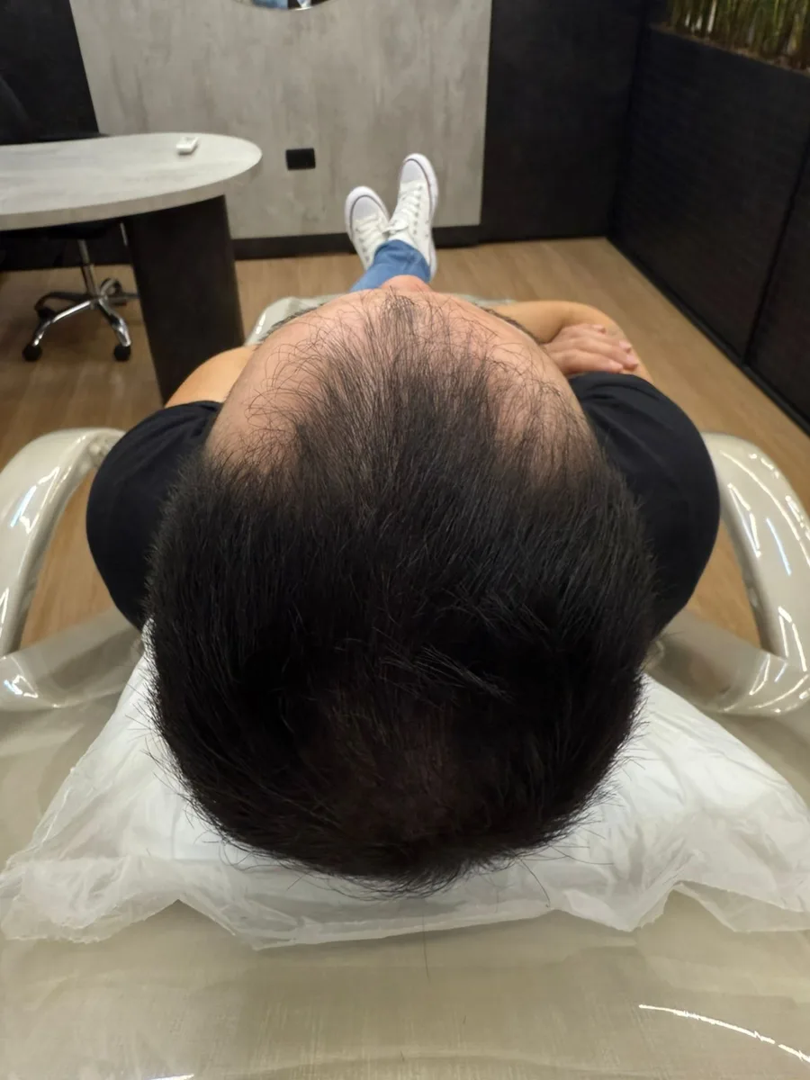 Depois do tratamento de calvície masculina